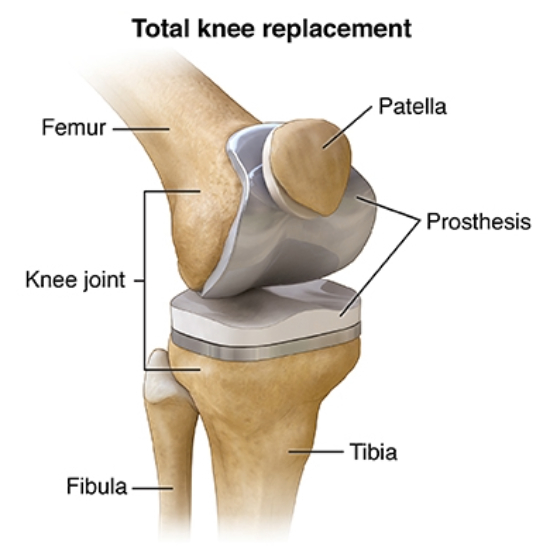 Total Knee Replacement